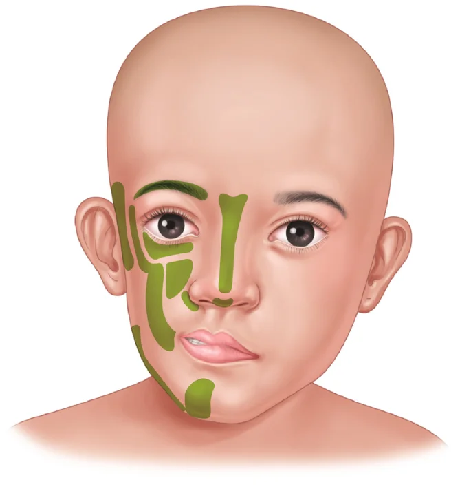Hemifacial Atrophy