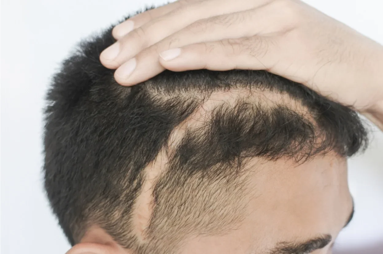 Burn Scar Hair Loss