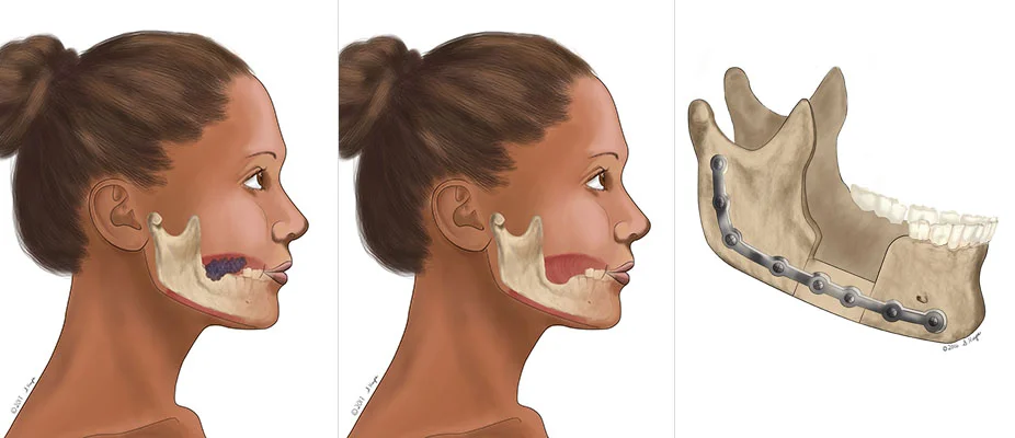 Jaw tumors