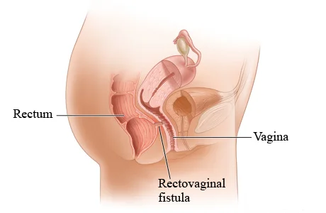 Vaginal Fistula