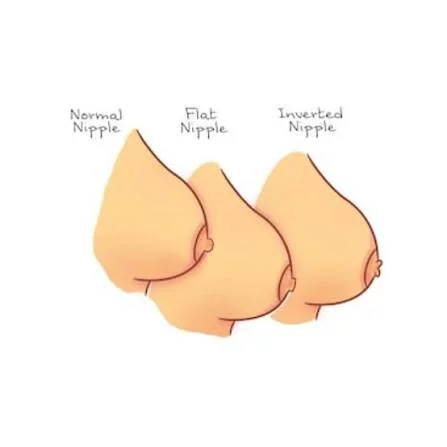 Nipple Deformities
