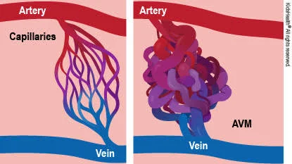 High-Flow Vascular Malformations