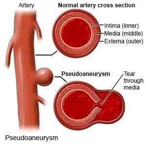 Pseudoaneurysms