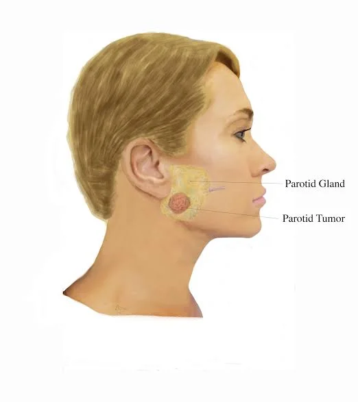 Parotid Tumor