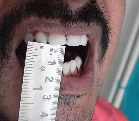 Oral Submucous Fibrosis (OSMF)