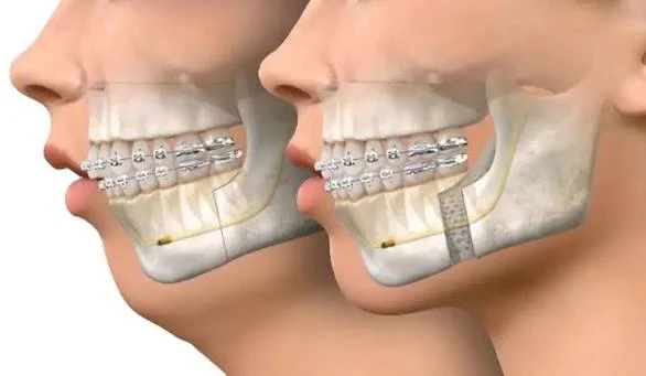 Bilateral Sagittal Split Osteotomy (BSSO)