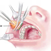 buccal-fat-removal buccal-fat-removal