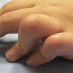 Avaliação do tratamento da camptodactilia: análise retrospect