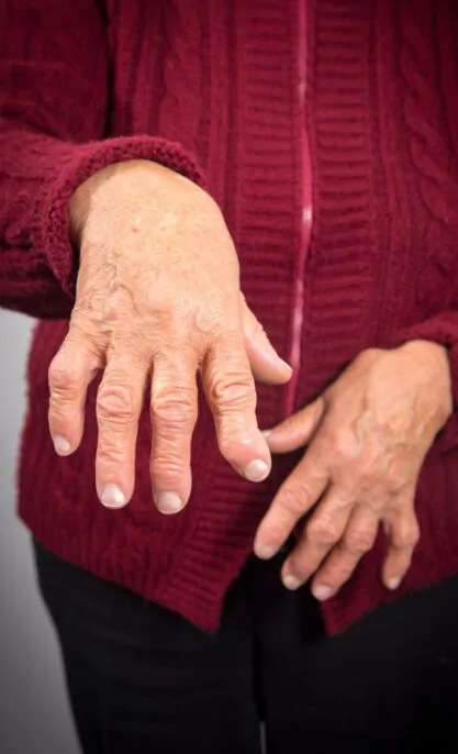 Hand Deformity Hand Deformity