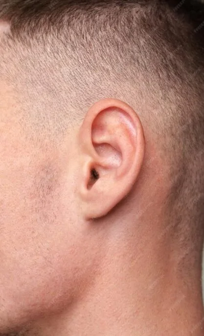 Ear correction Ear correction