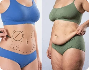 Abdomen liposuction