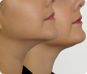 What Liposuction (Chin / Abdomen) Can Do 