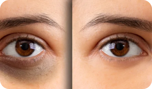 Dark Circles Treatment_