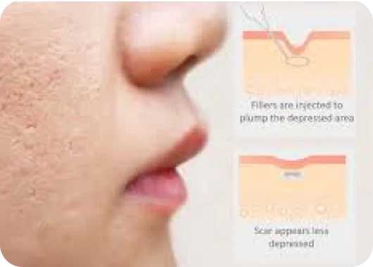 Dermal Fillers for Depressed Scars_