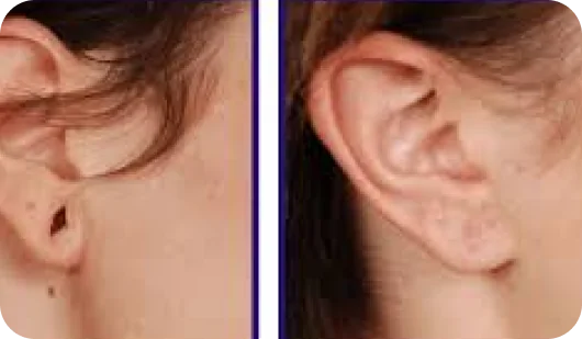 Ear Lobe Repair_