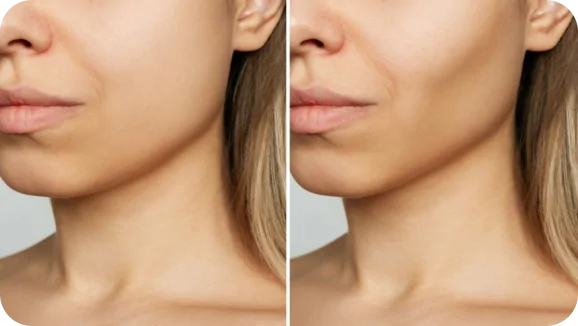 Facial Contouring Surgery_ Facial Contouring Surgery_