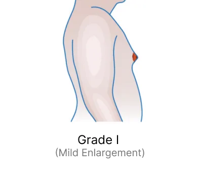 Grade I (Mild Enlargement)