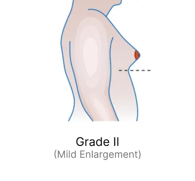 Grade II (Mild Enlargement)