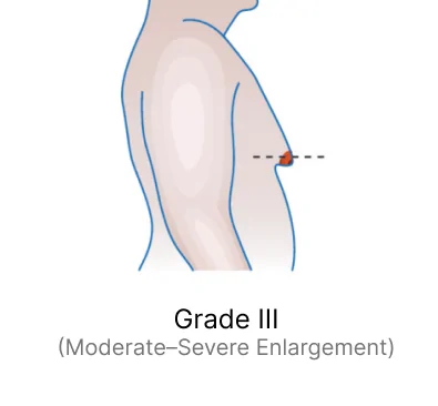 Grade III (Moderate–Severe Enlargement)