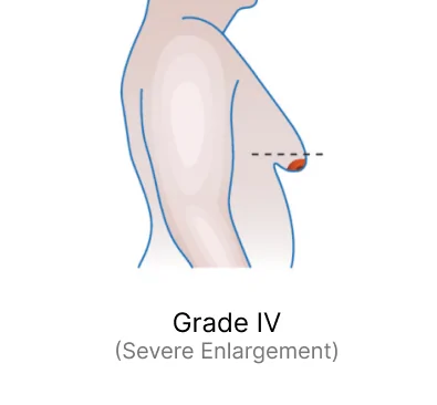 Grade IV (Severe Enlargement)