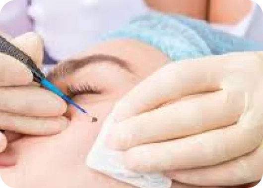 Laser Scar & Mole Treatment_ Laser Scar & Mole Treatment