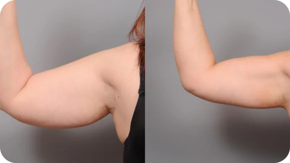 Liposuction of Arms_ Liposuction of Arms