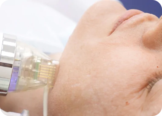 Microneedling & RF Microneedling_ Microneedling