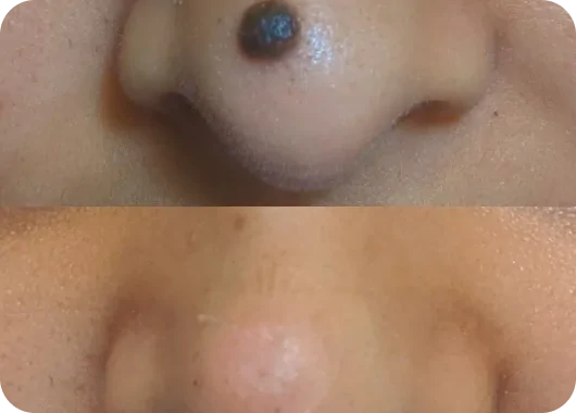 Mole Removal (Shave Technique)_