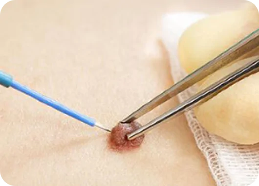 Mole Removal (Surgical Excision)_