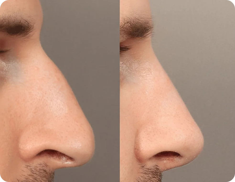 Rhinoplasty