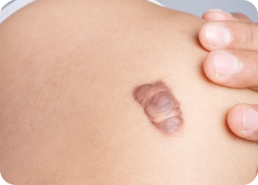 Steroid or Anti-Inflammatory Injections (for Keloids & Hypertrophic Scars)_ Steroid or Anti-Inflammatory Injections