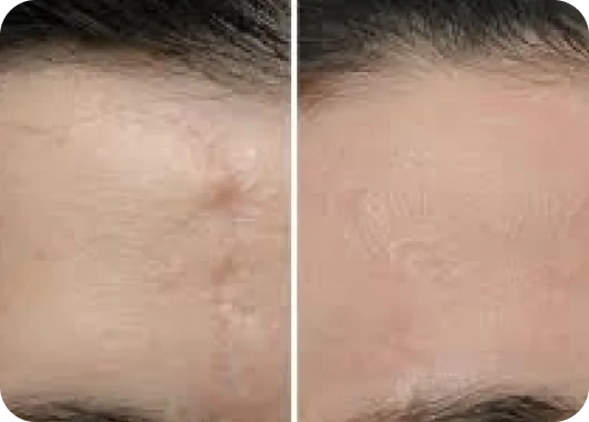 Surgical Scar Revision_ Surgical Scar Revision