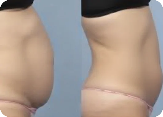 Tumescent Liposuction_ Tumescent Liposuction