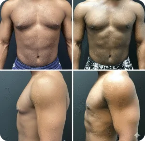 What Gynecomastia Can Do for You