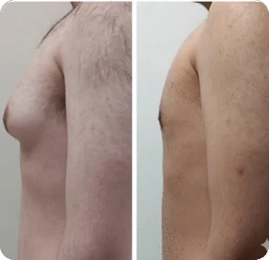 Why Choose Kayakriti for Your Gynecomastia