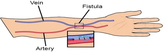 AV fistula