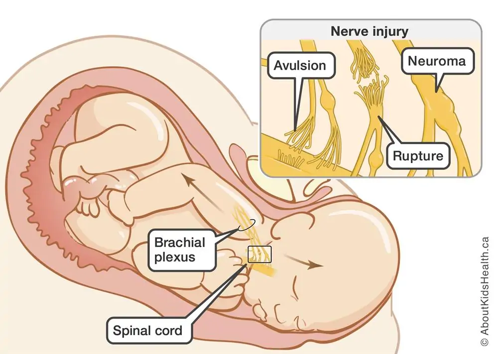 BrachialPlexus_Contracture_Birth_EN