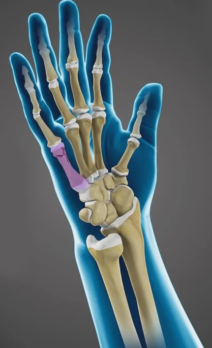 Fractures of the Hand and Fingers Fractures of the Hand and Fingers