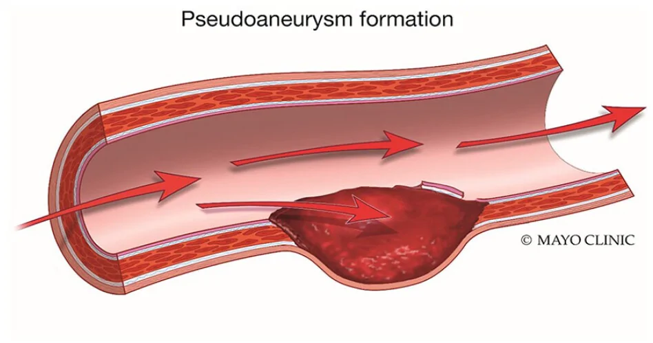 Pseudoaneurysm 1