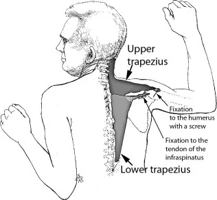 Schematic-representation-of-the-upper-and-lower-trapezius-muscle-transfer-The-upper