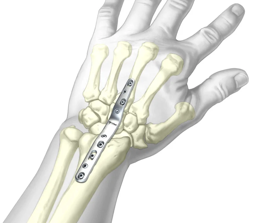 Total-Wrist-Fusion-Plate