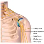 brachial-plexus-injury