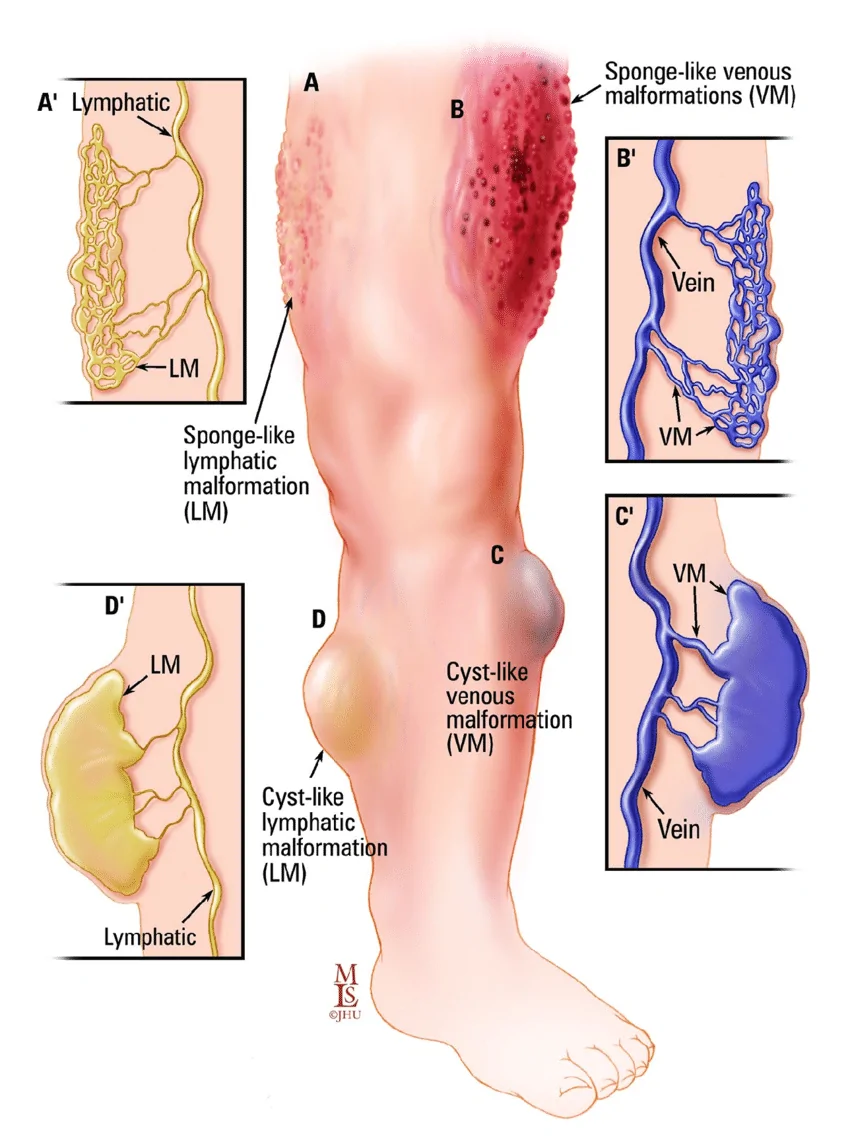 lymphatic-malformations